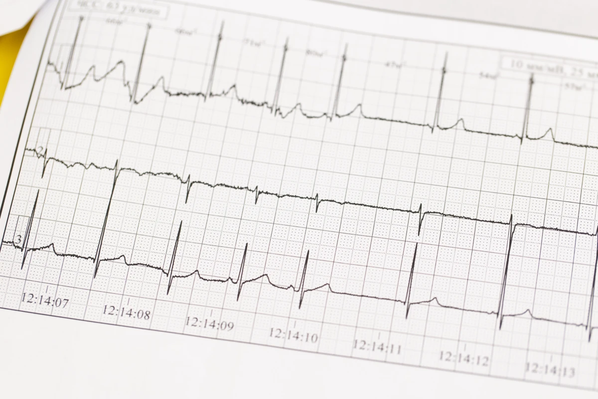 Exploration des effets du CBD sur les troubles du rythme cardiaque